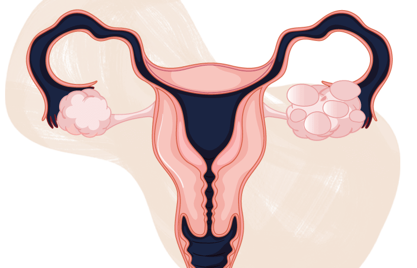 Polycystic Ovary Syndrome Market 2019 Global Analysis by Key Players