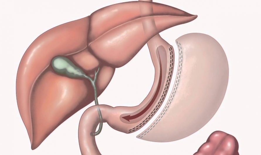 Bariatric Surgeries Market Analysis, and Forecast to 2020-2026