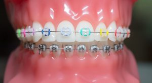 Ceramic Braces Market