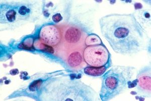 Chlamydia Infection Diagnostics Market