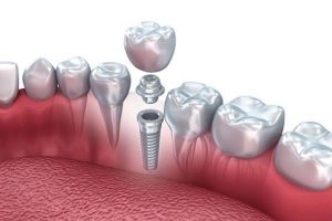 Cosmetic Implant Market