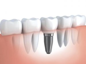 Dental Cements Market