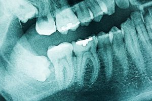 Dental Imaging Market