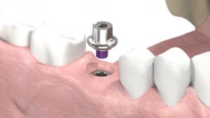 Dental Implants And Prosthetics Market
