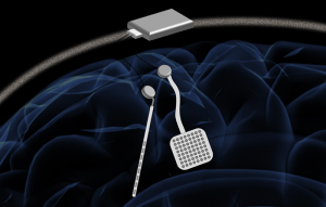 External Neurostimulation Device Market