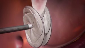 PFO Closure Device Market