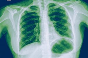 Pneumonia Diagnostic Market