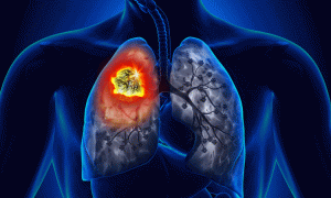 Small Cell Lung Cancer Treatment Market