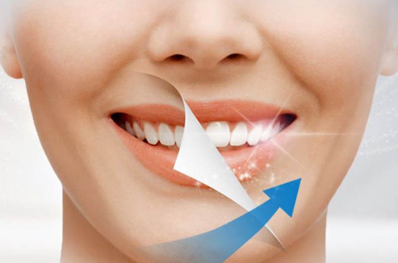 Tooth Whitening Instrument Market Major Manufacturers, Trends,