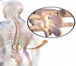Bone Allograft and Xenograft Market
