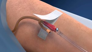 Catheter Stabilization Device Market
