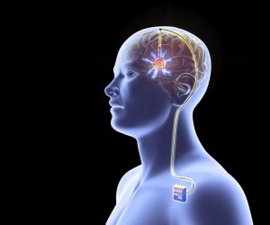 Deep Brain Stimulation Devices Market