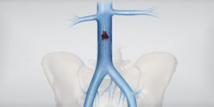 Inferior Vena Cava (IVC) Filters Market
