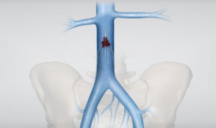 Inferior Vena Cava (IVC) Filters Market