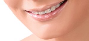Invisible Braces Market