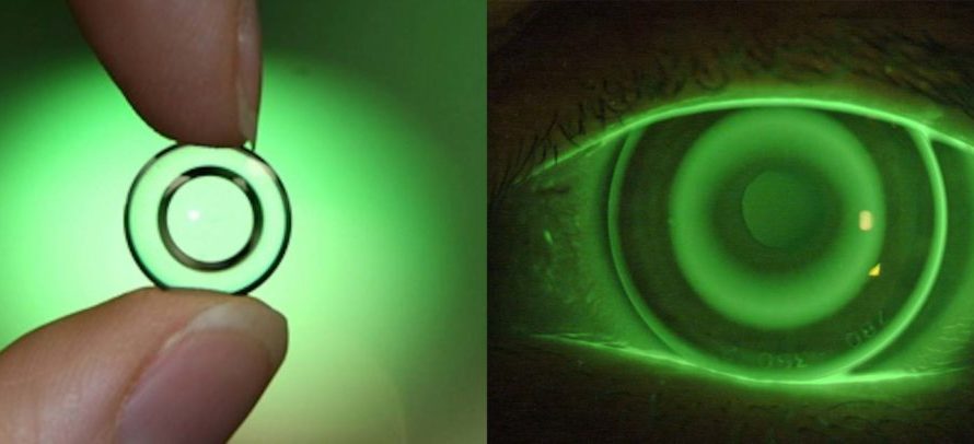 Orthokeratology Lens Market 2020 Global Analysis, Research