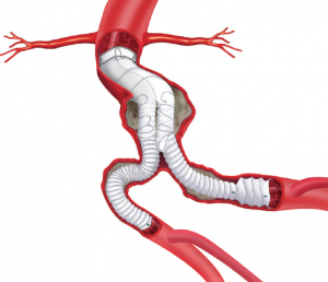 Stent Grafts Market