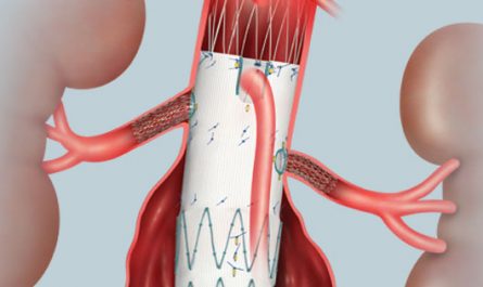 Abdominal Aortic Aneurysm (AAA) Repair Devices Market