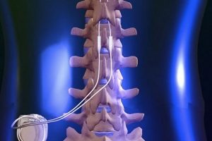 Spinal Trauma Devices Market